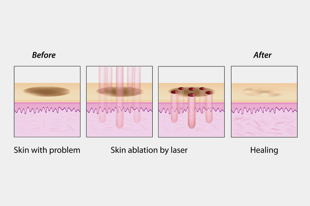 Skin resurfacing treatment